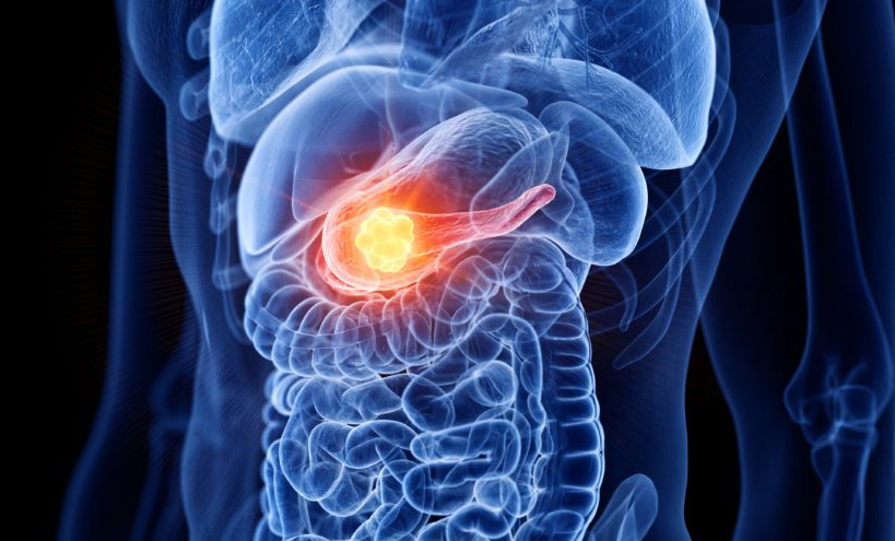 StockWatch: Revolution’s Phase III Pancreatic Cancer Data Dazzles Investors, Analysts