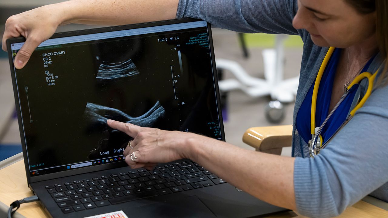 What is PMOS (formerly PCOS)? What to know about the hormonal syndrome
